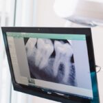 Close-up of a dental x-ray displayed on a monitor in a dental office.