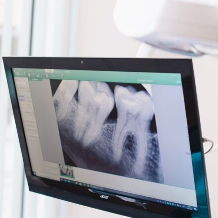 Close-up of a dental x-ray displayed on a monitor in a dental office.