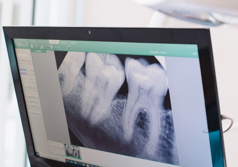 Close-up of a dental x-ray displayed on a monitor in a dental office.