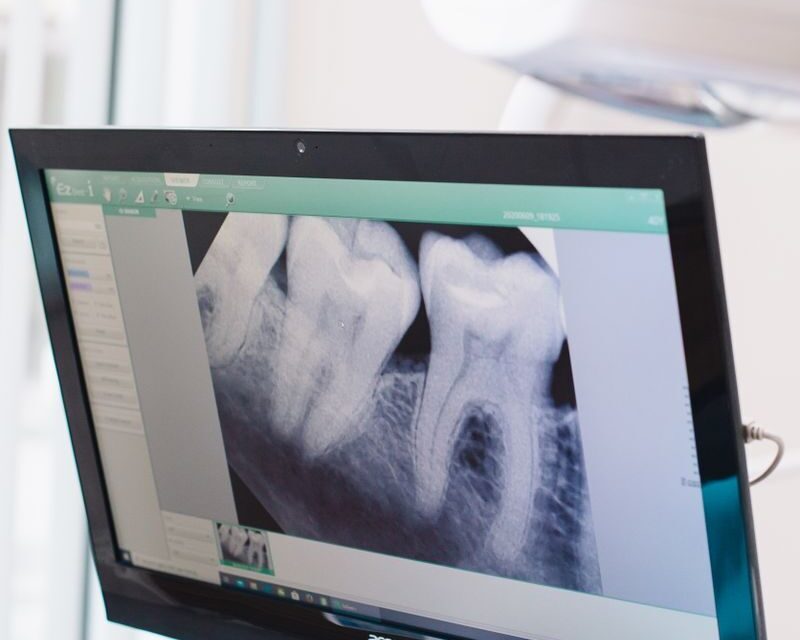 Close-up of a dental x-ray displayed on a monitor in a dental office.